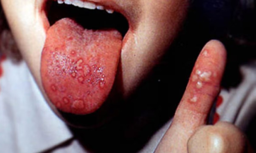 Alerta sobre o vírus Coxsackie se espalhando entre crianças