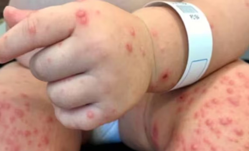 Alerta sobre o vírus Coxsackie se espalhando entre crianças: o que ele causa e quão sério é